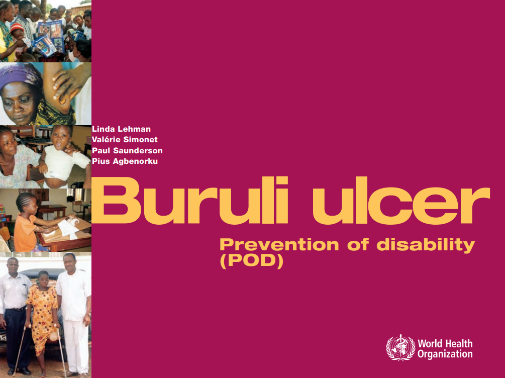 buruli ulcer