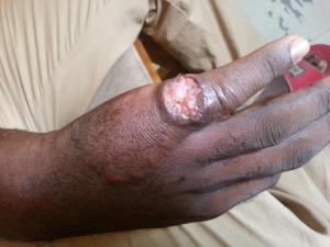 A patient diagnosed with Cutaneous Leishmaniasis.jpg