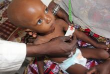 Umaru, one of over 500,000 severely malnourished children in north-east Nigeria being screened for adequate therapeutic intervention. 